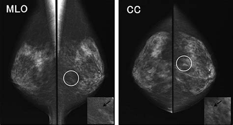 微細石灰化の集簇|乳がん検診のマンモグラフィ検査で石灰化があった場合について。